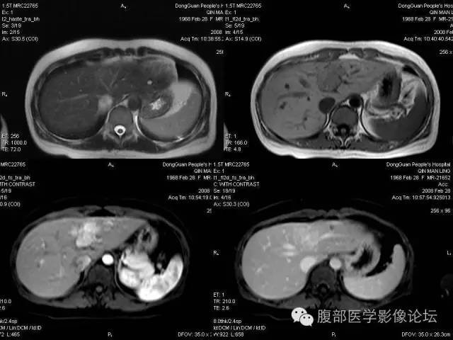 【PPT】肝内胆管细胞癌影像学诊断 【PPT】肝内胆管细胞癌影像学诊断