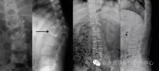 脊柱结核分型图片详解