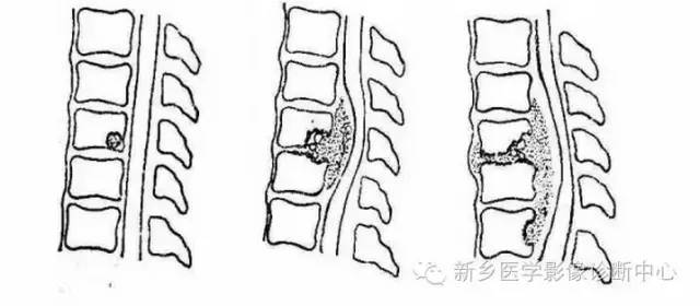 脊柱结核分型图片详解
