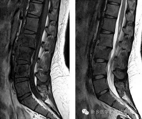 脊柱结核分型图片详解