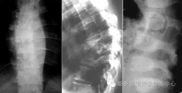脊柱结核分型图片详解