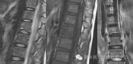 脊柱结核分型图片详解
