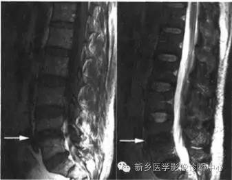 脊柱结核分型图片详解