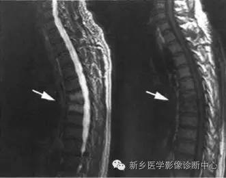 脊柱结核分型图片详解