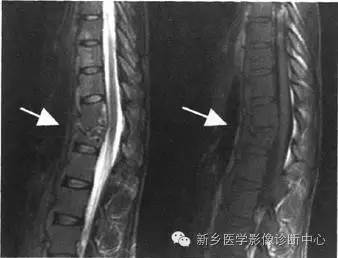 脊柱结核分型图片详解