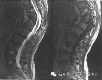 脊柱结核分型图片详解