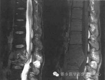 脊柱结核分型图片详解