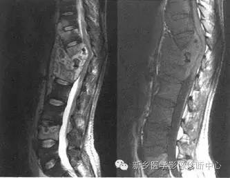 脊柱结核分型图片详解