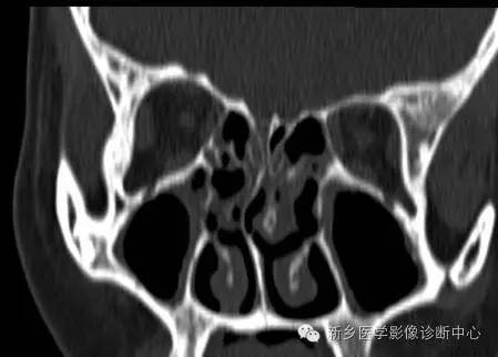 Kartagener综合征 Kartagener综合征