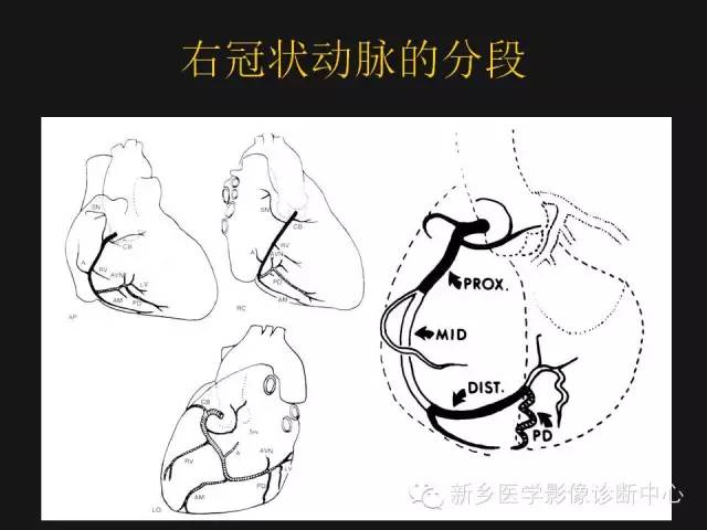 【PPT】冠状动脉造影解剖