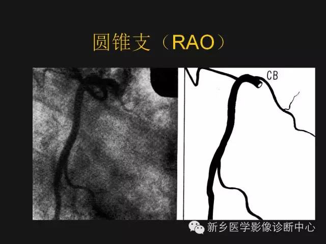 【PPT】冠状动脉造影解剖