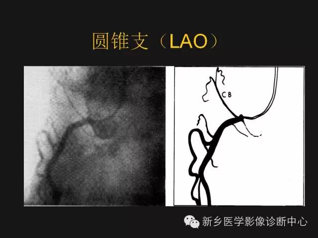 【PPT】冠状动脉造影解剖