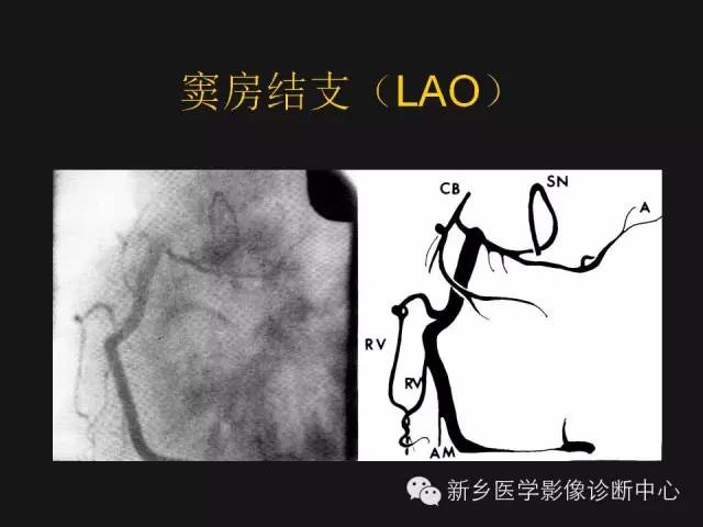 【PPT】冠状动脉造影解剖
