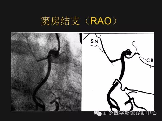 【PPT】冠状动脉造影解剖
