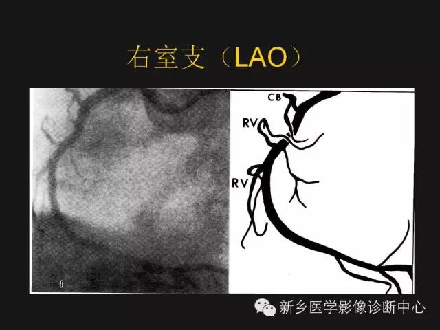 【PPT】冠状动脉造影解剖