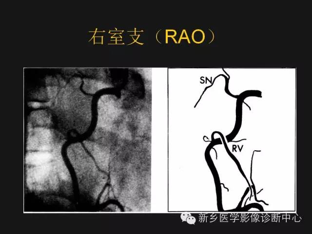 【PPT】冠状动脉造影解剖