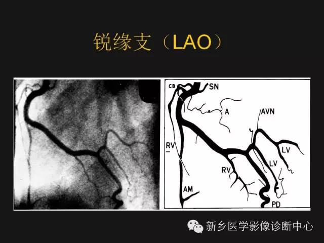 【PPT】冠状动脉造影解剖