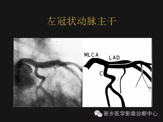 【PPT】冠状动脉造影解剖