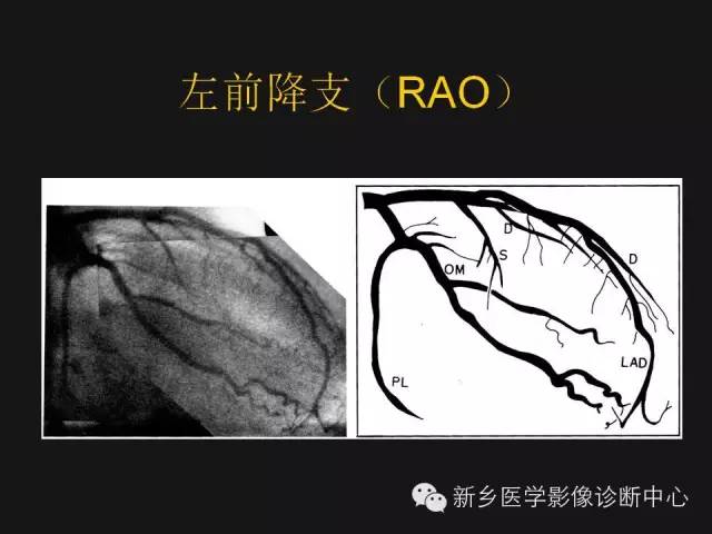【PPT】冠状动脉造影解剖