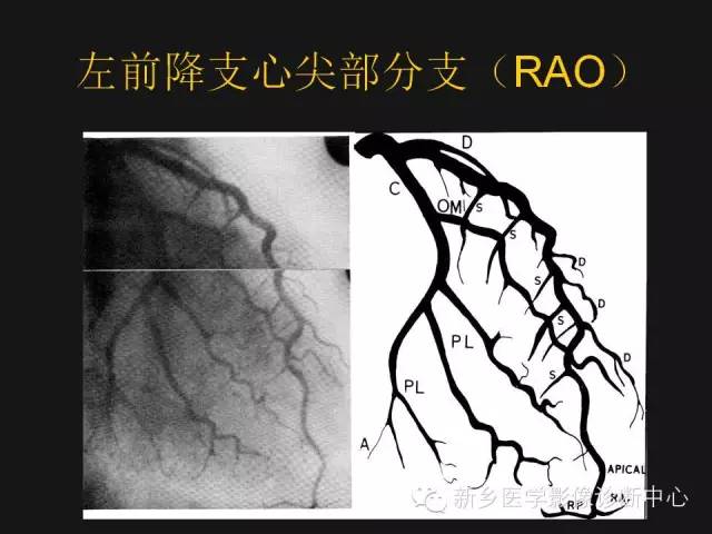 【PPT】冠状动脉造影解剖