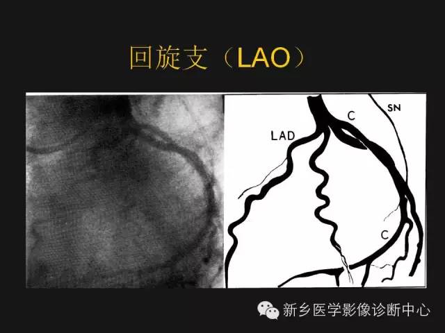 【PPT】冠状动脉造影解剖