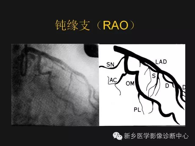 【PPT】冠状动脉造影解剖