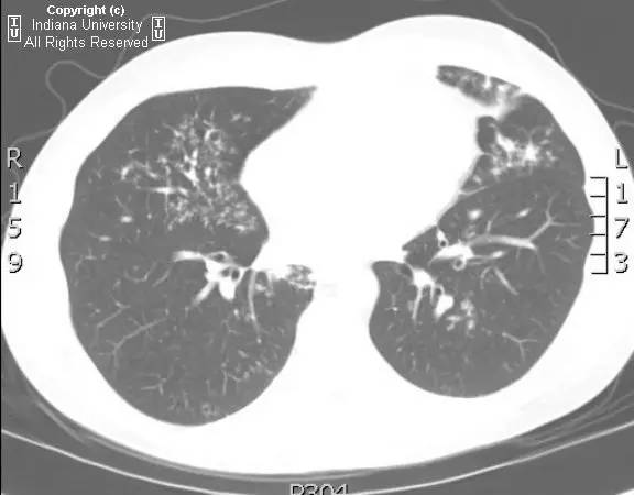 【病例】继发性肺结核1例X线及CT影像表现 【病例】继发性肺结核1例X线及CT影像表现