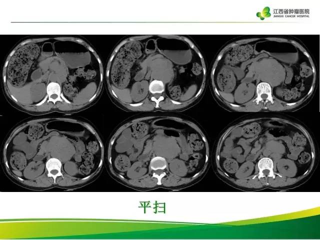 【病例】腹膜后异位嗜铬细胞瘤1例CT影像分析