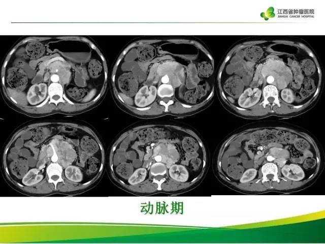【病例】腹膜后异位嗜铬细胞瘤1例CT影像分析
