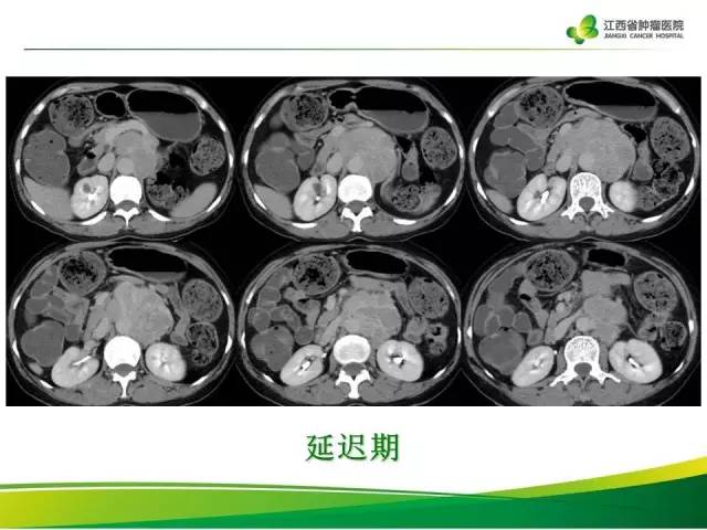 【病例】腹膜后异位嗜铬细胞瘤1例CT影像分析