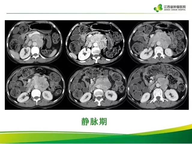 【病例】腹膜后异位嗜铬细胞瘤1例CT影像分析