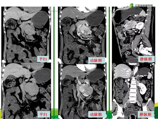 【病例】腹膜后异位嗜铬细胞瘤1例CT影像分析