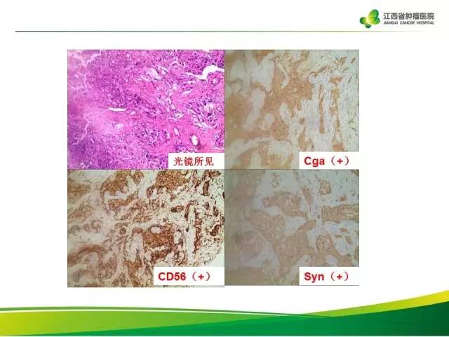 【病例】腹膜后异位嗜铬细胞瘤1例CT影像分析