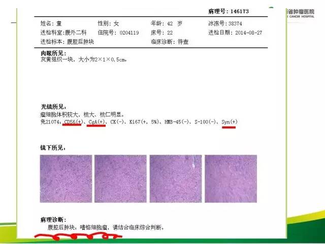 【病例】腹膜后异位嗜铬细胞瘤1例CT影像分析