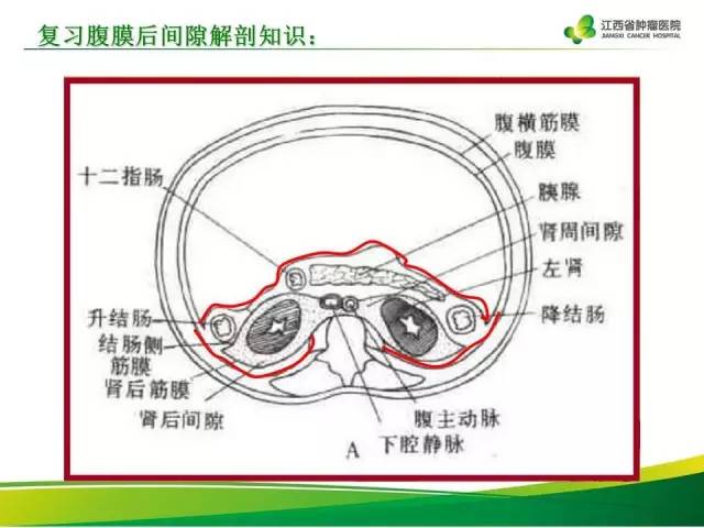 【病例】腹膜后异位嗜铬细胞瘤1例CT影像分析