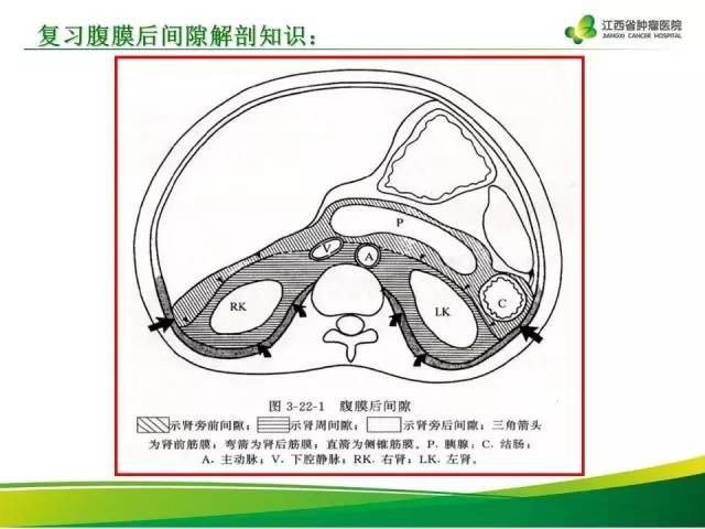 【病例】腹膜后异位嗜铬细胞瘤1例CT影像分析