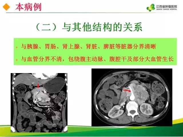 【病例】腹膜后异位嗜铬细胞瘤1例CT影像分析