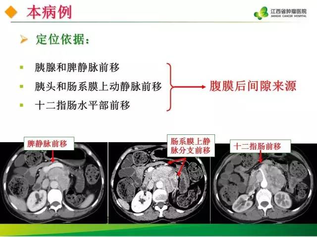 【病例】腹膜后异位嗜铬细胞瘤1例CT影像分析