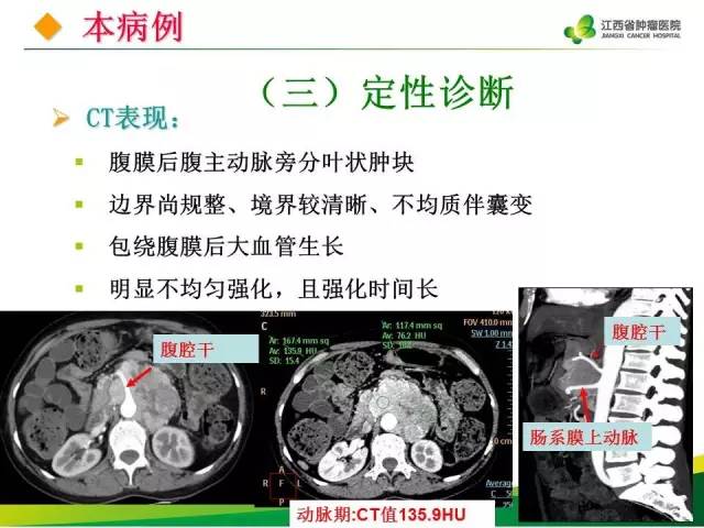 【病例】腹膜后异位嗜铬细胞瘤1例CT影像分析