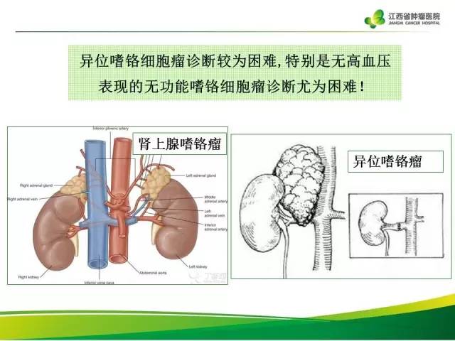 【病例】腹膜后异位嗜铬细胞瘤1例CT影像分析