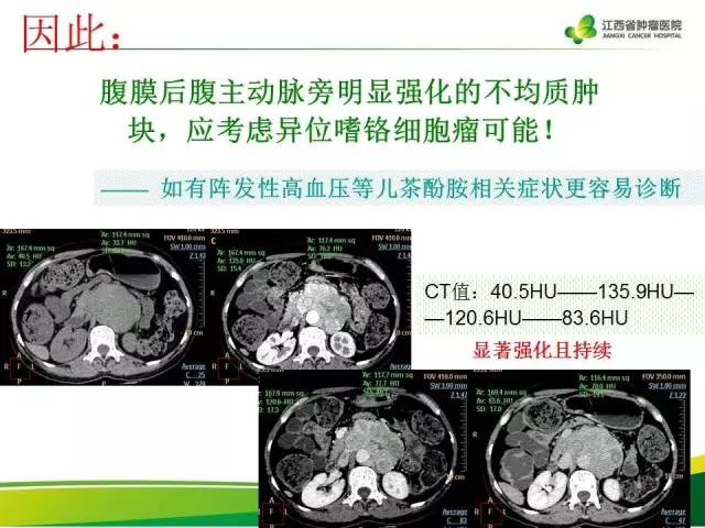 【病例】腹膜后异位嗜铬细胞瘤1例CT影像分析