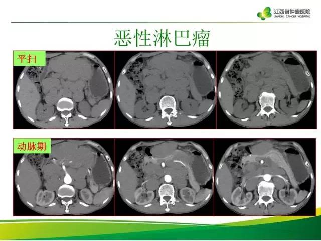 【病例】腹膜后异位嗜铬细胞瘤1例CT影像分析