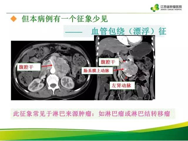 【病例】腹膜后异位嗜铬细胞瘤1例CT影像分析