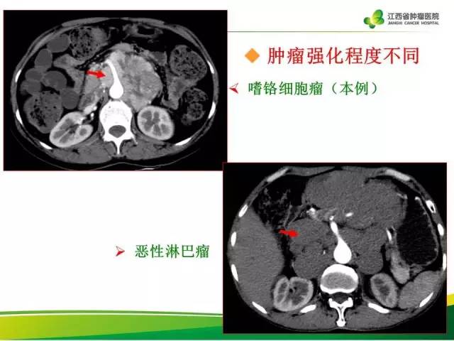 【病例】腹膜后异位嗜铬细胞瘤1例CT影像分析