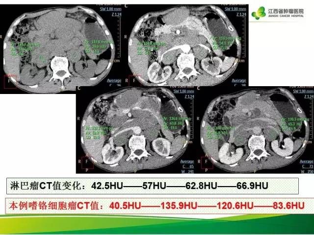 【病例】腹膜后异位嗜铬细胞瘤1例CT影像分析