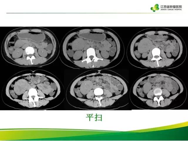 【病例】腹膜后巨淋巴增生症1例CT影像表现