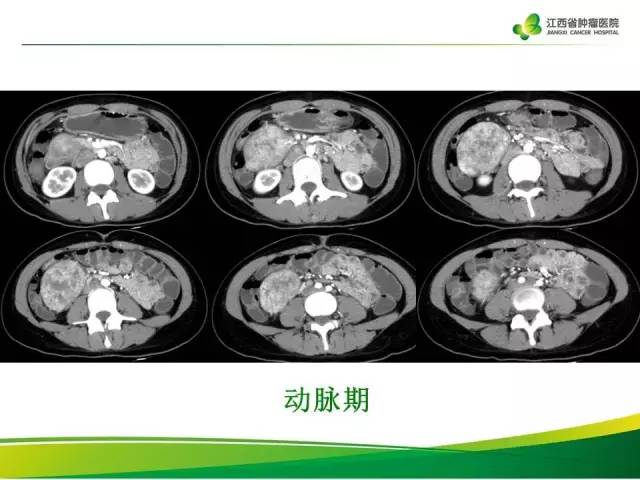 【病例】腹膜后巨淋巴增生症1例CT影像表现