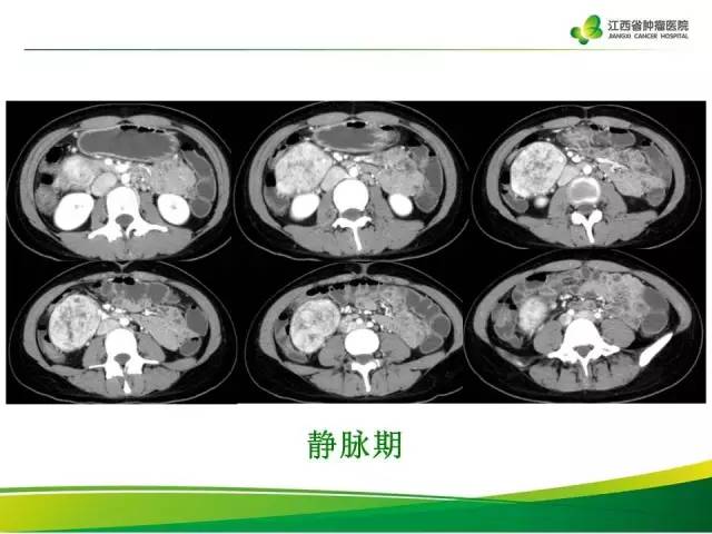 【病例】腹膜后巨淋巴增生症1例CT影像表现