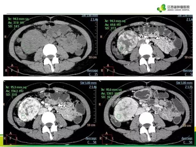 【病例】腹膜后巨淋巴增生症1例CT影像表现