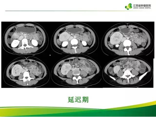 【病例】腹膜后巨淋巴增生症1例CT影像表现